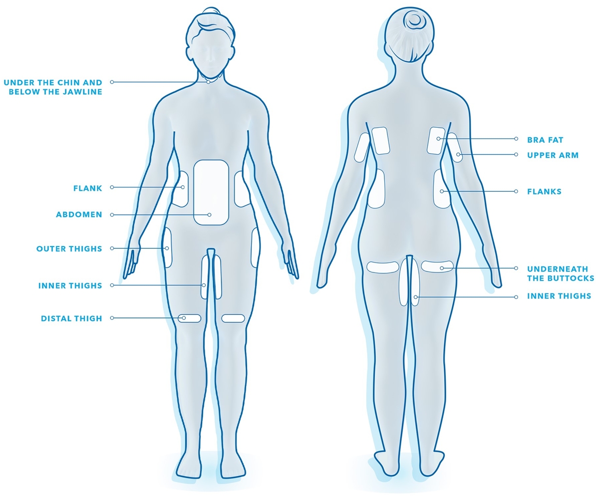 coolsculpting treatment areas