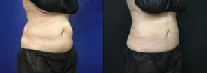 abdomen before after