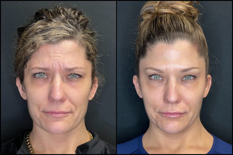 front facing before and after botox photo