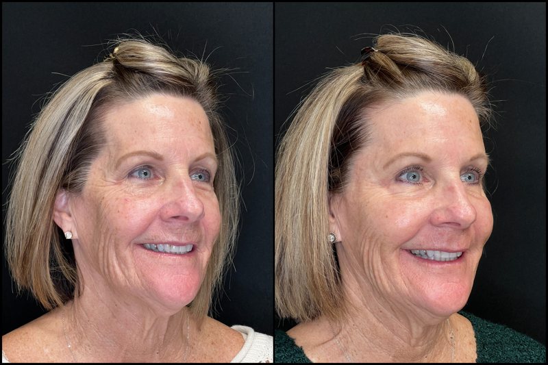 middle aged woman before and after botox photos