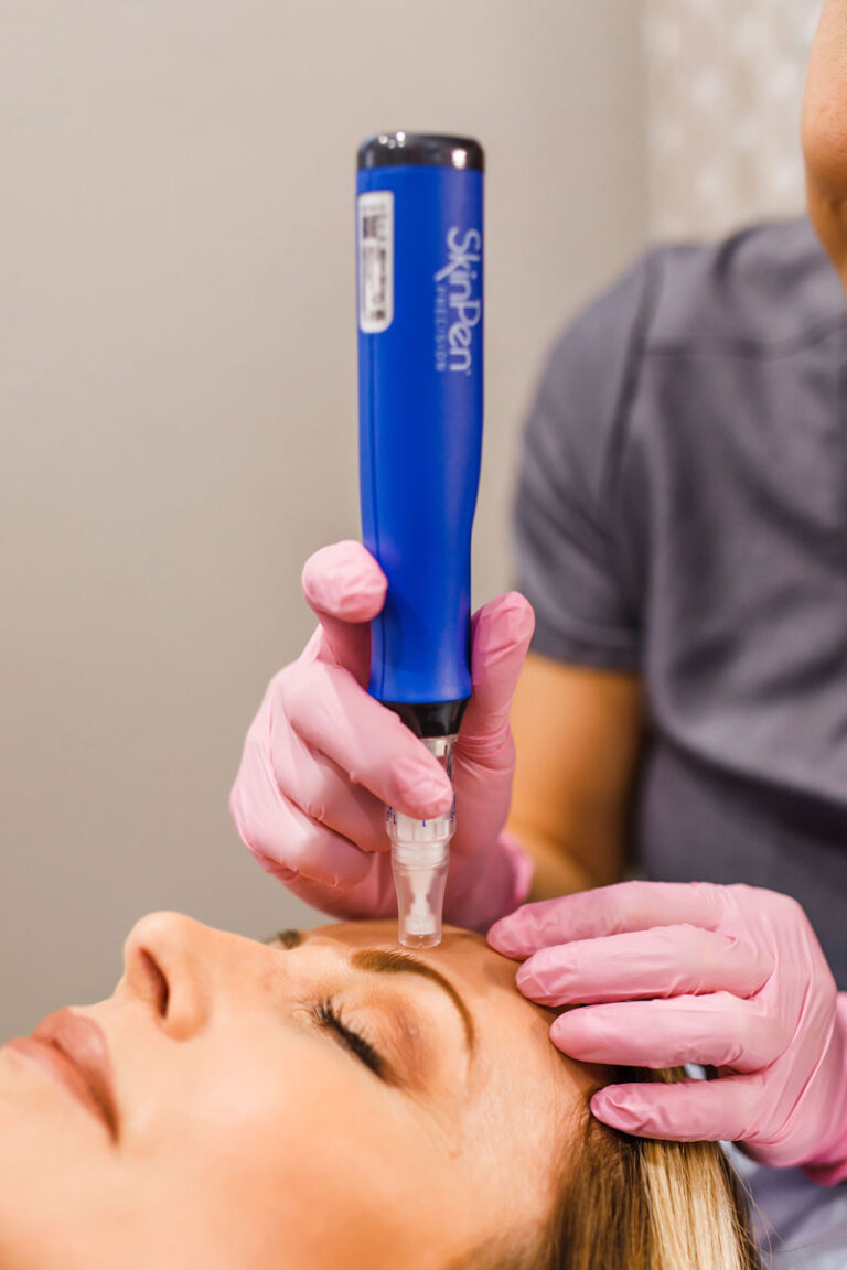 Microneedling for Auburn & Roseville, CA Vibrance Medical Spa