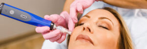 skinpen microneedling treatment