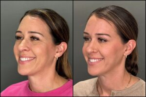 Botox-1-100units-2025