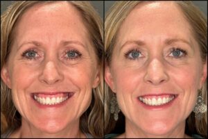 Botox-1-100units-2025