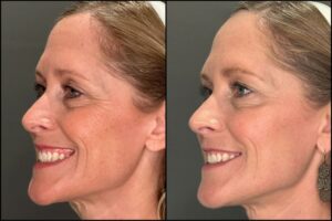 Botox-1-100units-2025