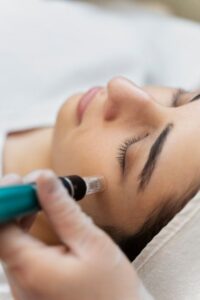 microneedling-vibrance-medical-spa