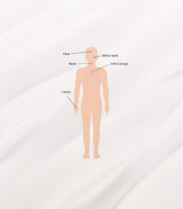 CoolPeel CO2 laser treatment areas face neck chest hands Auburn Lincoln CA
