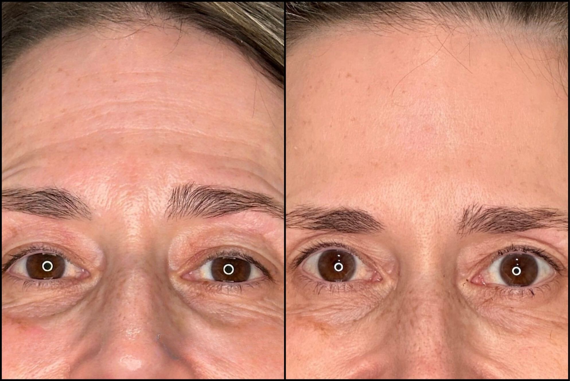 Forehead Botox before/after