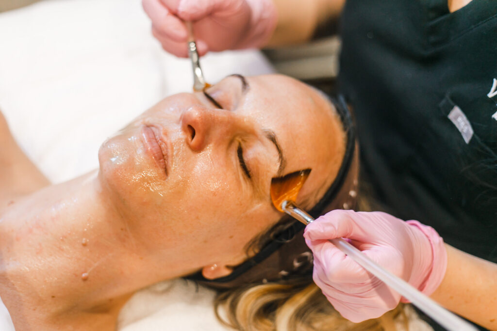 Best chemical peel in Auburn and Lincoln CA
